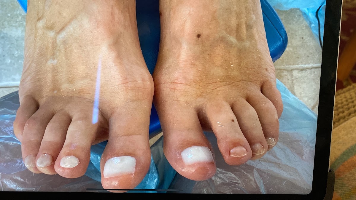 Silver tail foot care